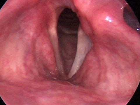 Stimmbandlähmung in Respiration Stimmbandlähmung Respiration