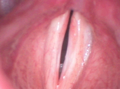 Stimmbandpolyp nach der OP Stimmbandpolyp nach der Operation