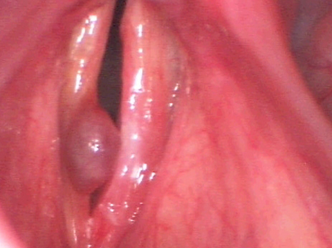 Stimmbandpolyp vor der OP Indikation für einen stimmchirurgischen Eingriff gegen einen Stimmbandpolyp